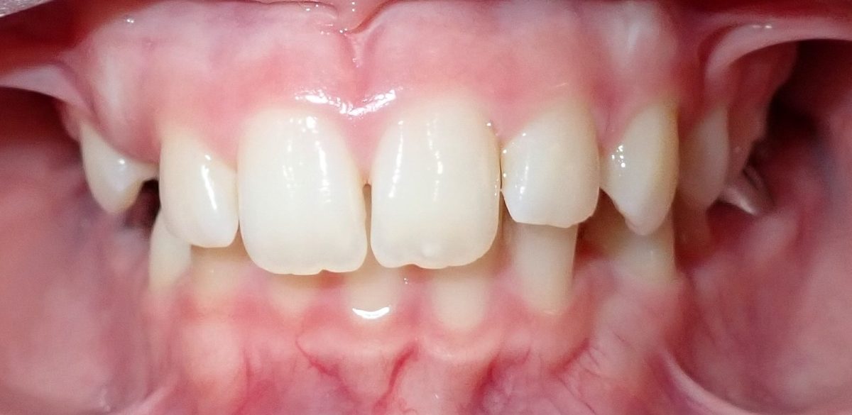 Vivid Smiles patient case 2 before and after treatment comparison before